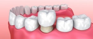 Full Mouth Rehabilitation with Dental Crowns in Islamabad