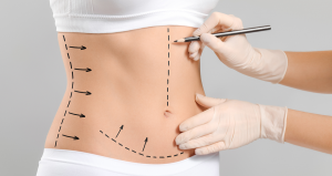 Day-by-Day Liposuction Recovery Diary (Islamabad Patient)