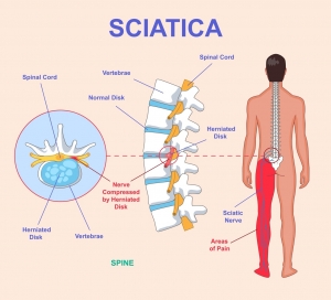 Understanding Sciatica – Symptoms, Causes & Effective Treatments