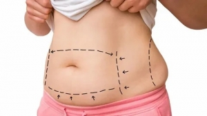 Before and After Results of Circumferential Abdominoplasty in Islamabad