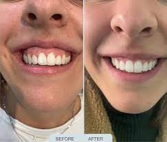 Are Gummy Smile Treatments Painful?