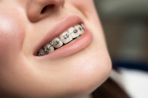 Smile Transformation: How to Choose Braces in Cupertino That Truly Fit Your Needs