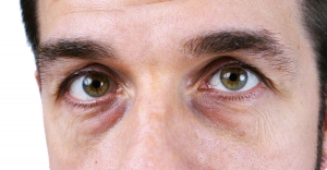 From Tired to Radiant: Why Under Eye Fillers Are Taking Over: