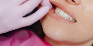 Understanding Wisdom Tooth Pain and Extraction in Tanjong Pagar & Tiong Bahru