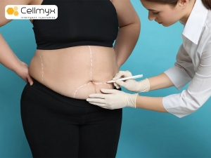 Liposuction Breast Fat Transfer: Enhance Your Curves Naturally