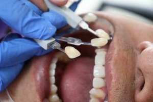 How to Care for Porcelain Veneers: A Complete Guide