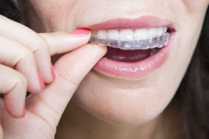 Beat Teeth Aligners in Islamabad | Clear Aligners for Perfect Smiles