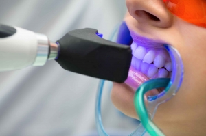 Teeth Whitening for Smokers in Islamabad