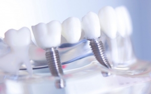 How Can Invisalign Dental Implants Transform Your Smile and Daily Life?