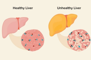 Comprehensive Fatty Liver Disease Treatment in Pune | Kaizen Liver Care