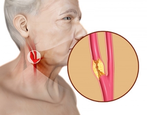 Carotid Treatment in Indore – Advanced Vascular Solutions for Stroke Prevention