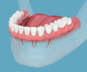 All-on-4 Dental Implants: The Smart Solution for Full Mouth Restoration