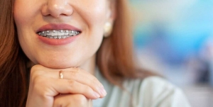 What to Know Before Getting Braces or Aligners