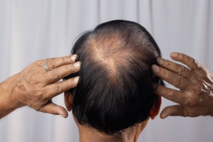 What Sets Exosomes Therapy Apart for Hair Loss in Riyadh