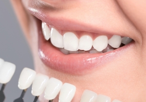What to Expect During Your Veneers Appointment in Islamabad
