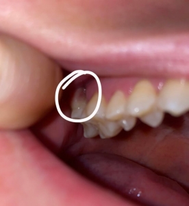 What Are Impacted Wisdom Teeth?