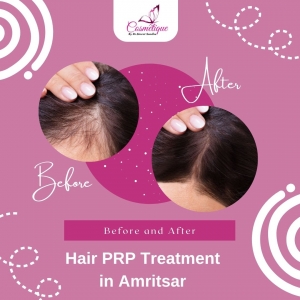 PRP Treatment: The Revolutionary Hair Therapy at Cosmetique by Simrat Sandhu.