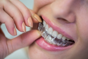 The Strategic Imperative: Integrating Transparent Teeth Braces for Modern Orthodontic Practice