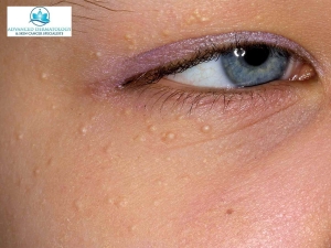 Why Do Milium Cysts Form and How Can You Stop Them?