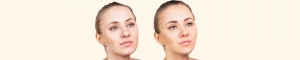 How to Choose the Best Treatment for Your Summer Skin Type Based on Acne Scars