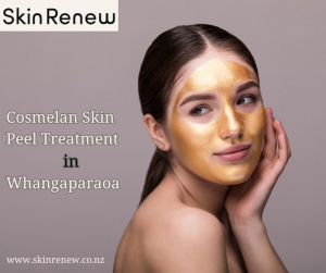 Effective Cosmelan Treatment in Whangaparaoa at Skin Renew