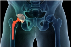 The Future of Hip Surgery: Direct Anterior Approach for Total Hip Replacement in Delhi