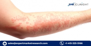 What is Driving the United States Hereditary Angioedema Therapeutics Market?