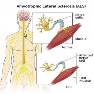 Stem Cell Treatment for ALS in India
