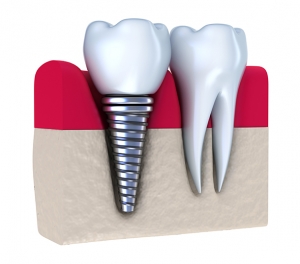 What Is The Procedure For Getting Dental Crowns In Atlanta?
