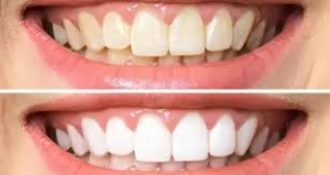 Professional vs. Home Whitening Kits: Which Works Best in Jaipur’s Climate?