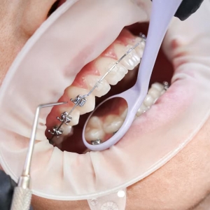 The Best Orthodontic Treatment Options Available in Westport, CT