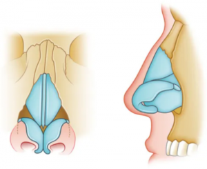 Nasal Fracture Treatment Risks, Complications, and How to Prevent Them
