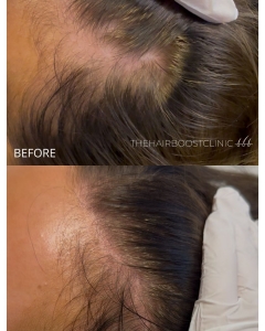 Top Hair Clinic Rotterdam – Herstel je haar bij The Hairboost Clinic
