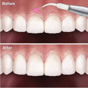 Gum Contouring Cost and What to Expect: A Complete Guide to Beautiful, Balanced Smiles