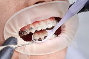 Modern Orthodontic Care in Los Angeles: What to Expect in 2025