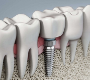 How Can Dental Implants Improve Oral Health And Functionality For Individuals In West Houston?