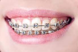 How Do You Clean and Care for Metal Braces?
