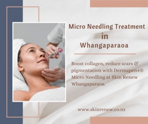 Want a Skin Refresh? Micro Needling Treatment in Whangaparaoa at Skin Renew
