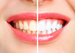 Professional Teeth Whitening vs. At-Home Whitening: Which Is Right for You?
