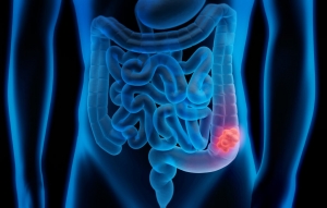 Colonoscopy: What It Detects, Risks, and Recovery Explained