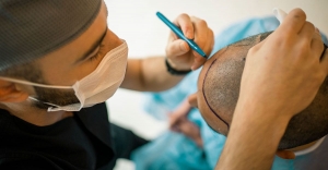 What You Need to Know About FUE Hair Transplant Cost