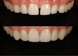 How to Take Care of Composite Veneers?