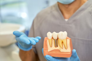 Life After Tooth Loss: How Dental Implants Restore Confidence and Function