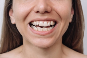 Do I Need Braces for Mild Tooth Overlap?