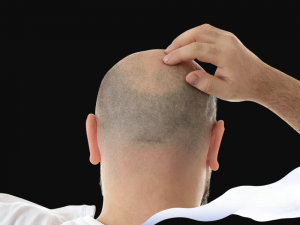 How Hair Transplants Can Help You Look and Feel Younger