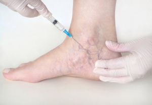 “Is Spider Veins Treatment in Islamabad Right for You?”