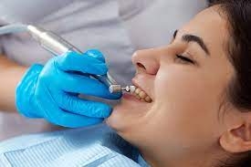 How Much Does Professional Teeth Cleaning Cost?
