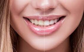 Can I Remove Coffee and Tea Stains from My Teeth?