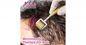 How Microneedle Therapy Helps You Regrow Stronger and Healthier Hair Naturally