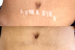 Scar Camouflage Restore Confidence & Balance